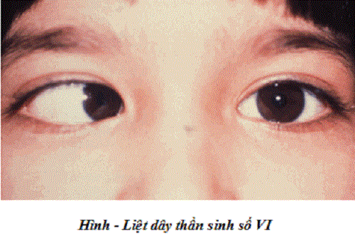 Liệt dây thần kinh số 6 - Hình ảnh minh họa